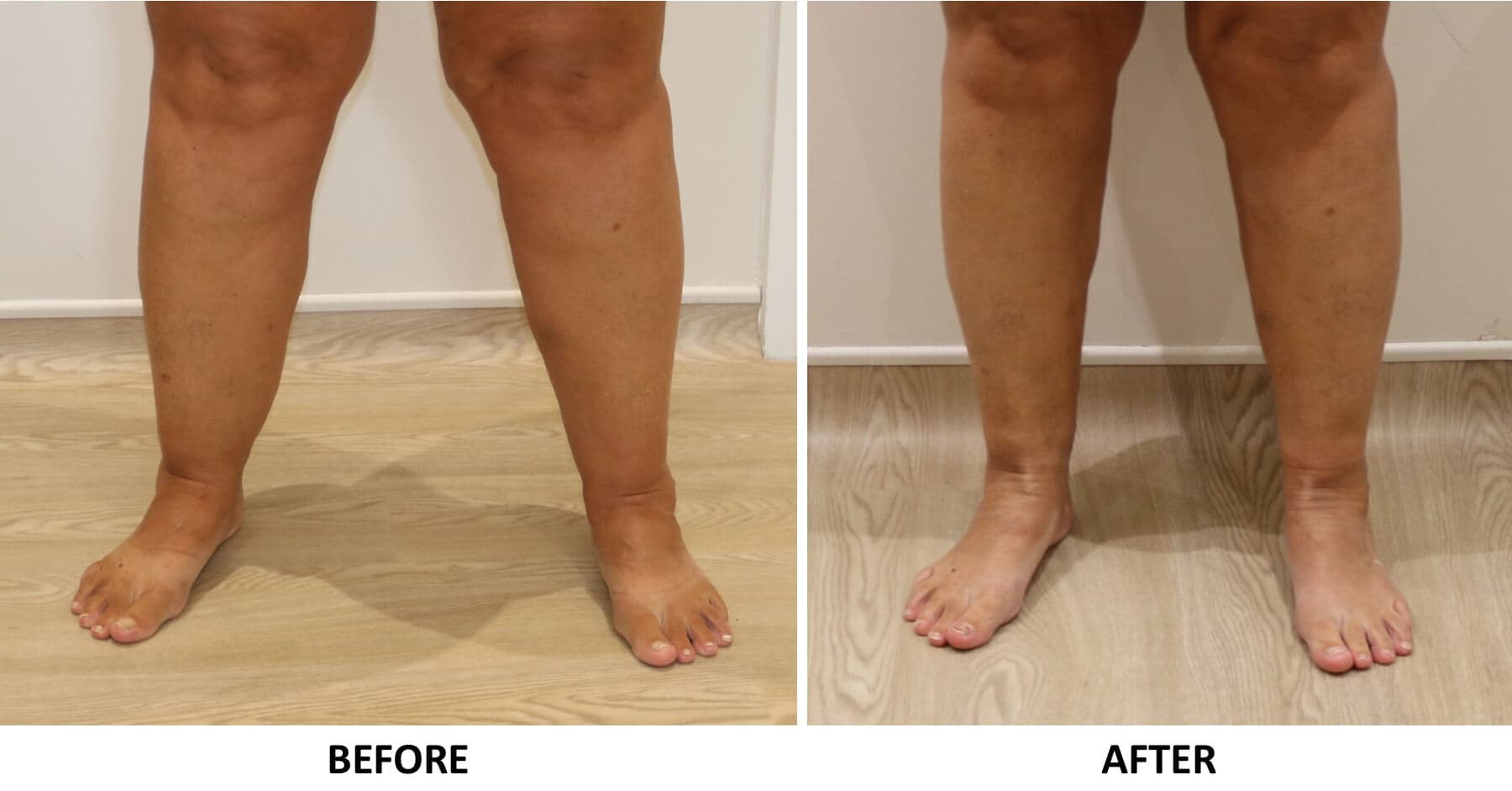 Ankle Contouring (Cankles) at The Karri Clinic