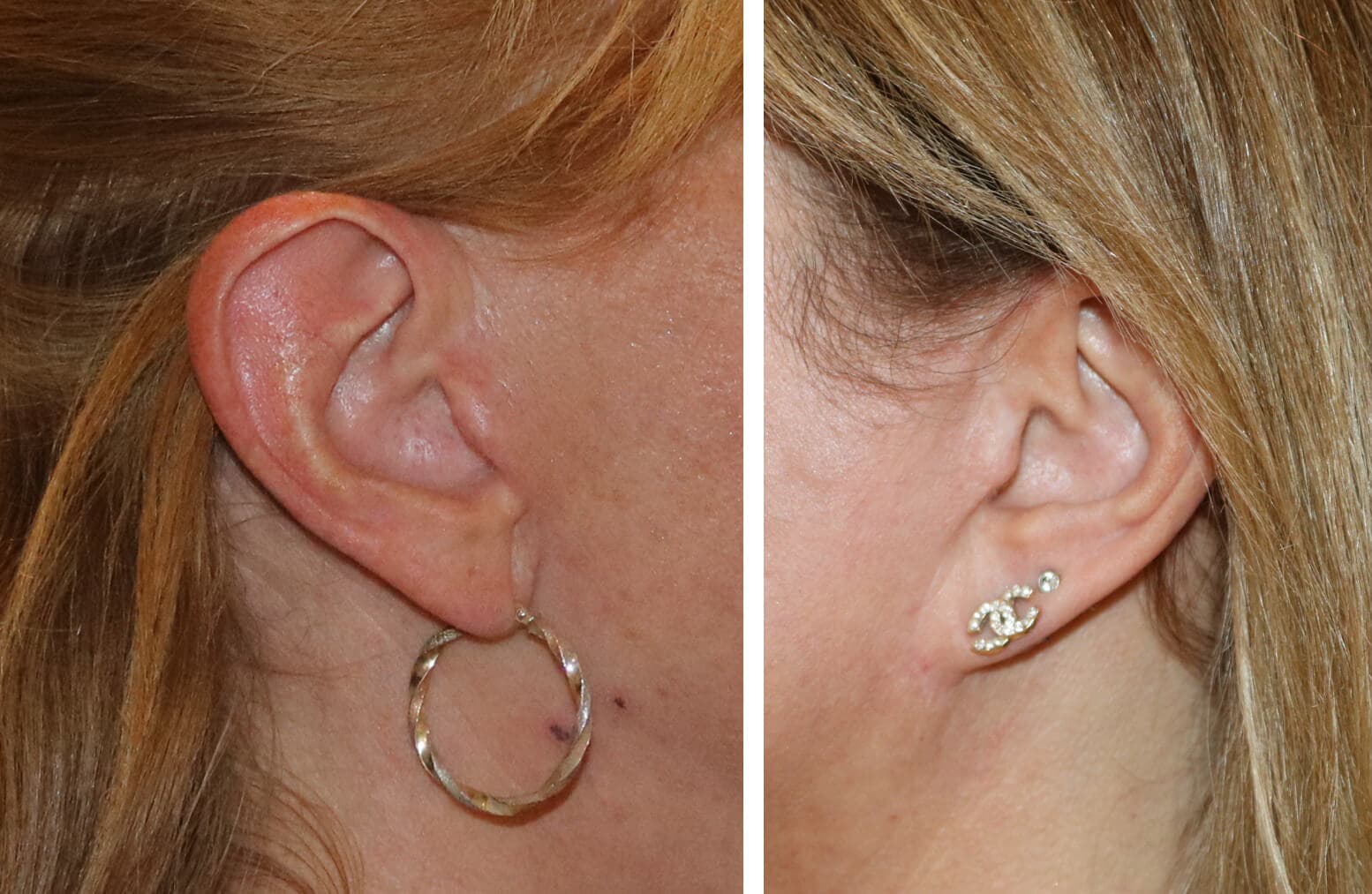 Facelift Scars - Mr Karri's Almost Invisible Method