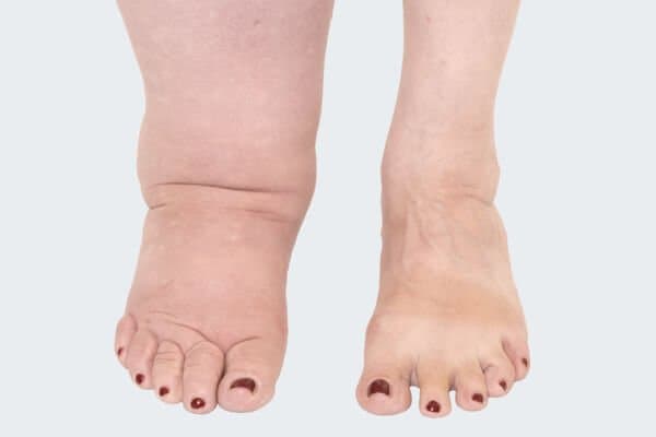 Lymphoedema Awareness Week 2019 - What is Lymphoedema?