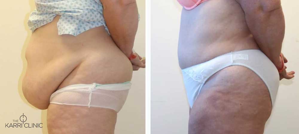 Everything you need to know about… a Tummy Tuck