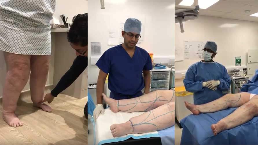 WATCH: Lower Limb Liposuction for Lipoedema | 5.2 Litres of Fat Removed
