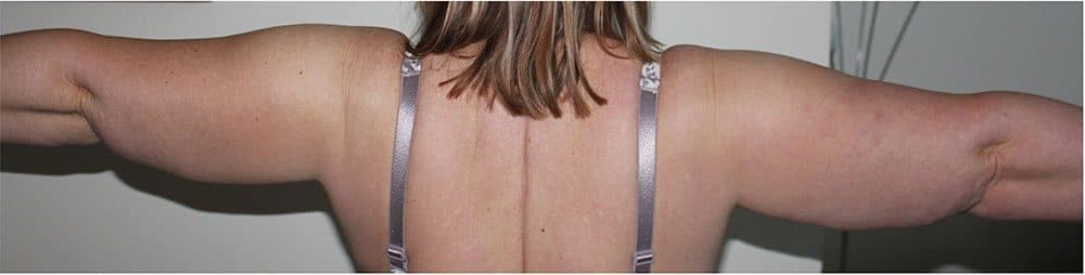 Arm Lipoedema Liposuction