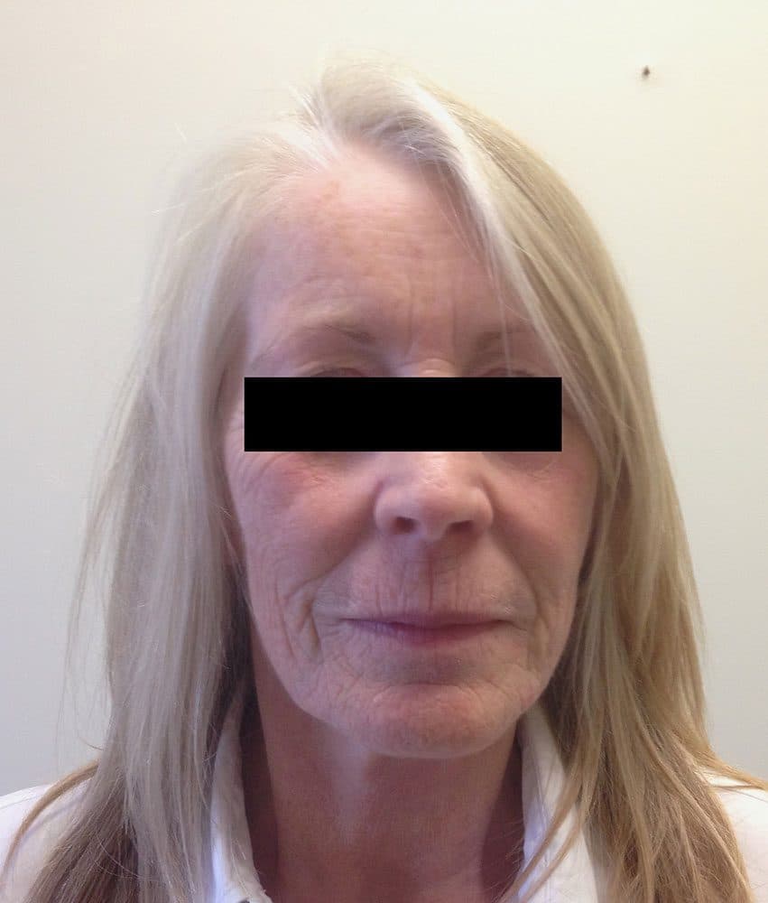 Facial Fat Grafting