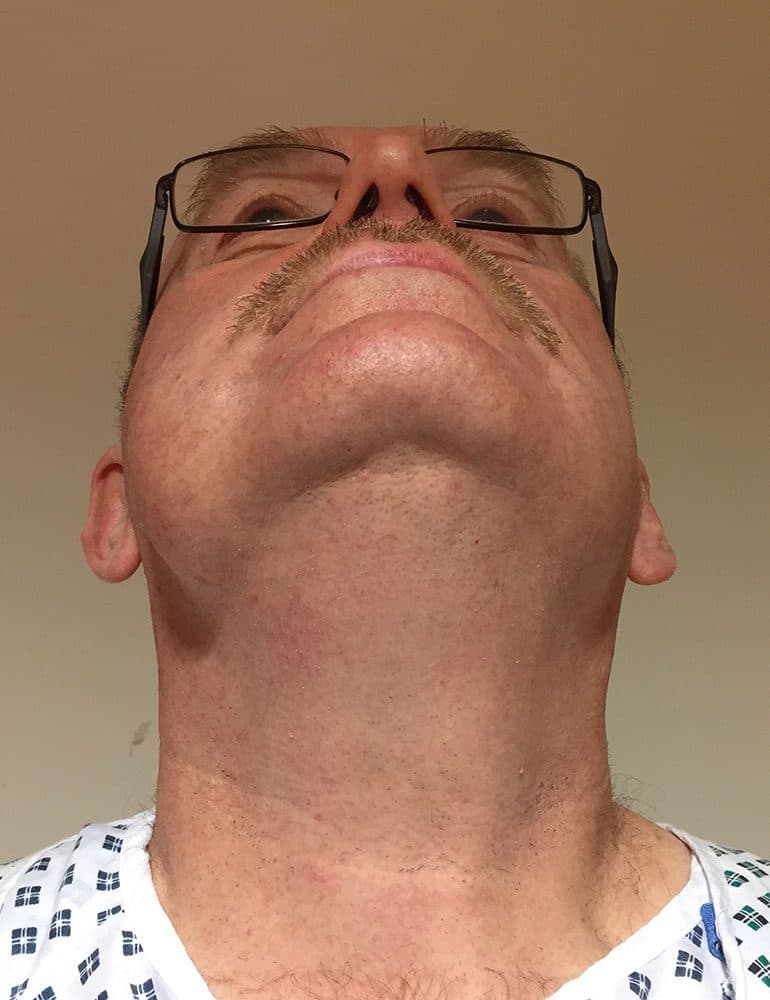 Facial Lipoma Excision