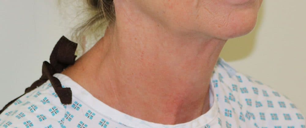Necklift