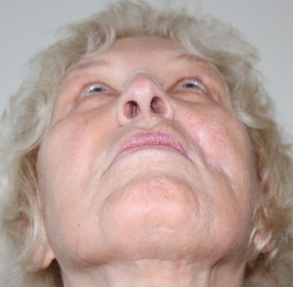 Scar Revision with Fat Grafting