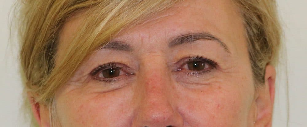 Upper Blepharoplasty