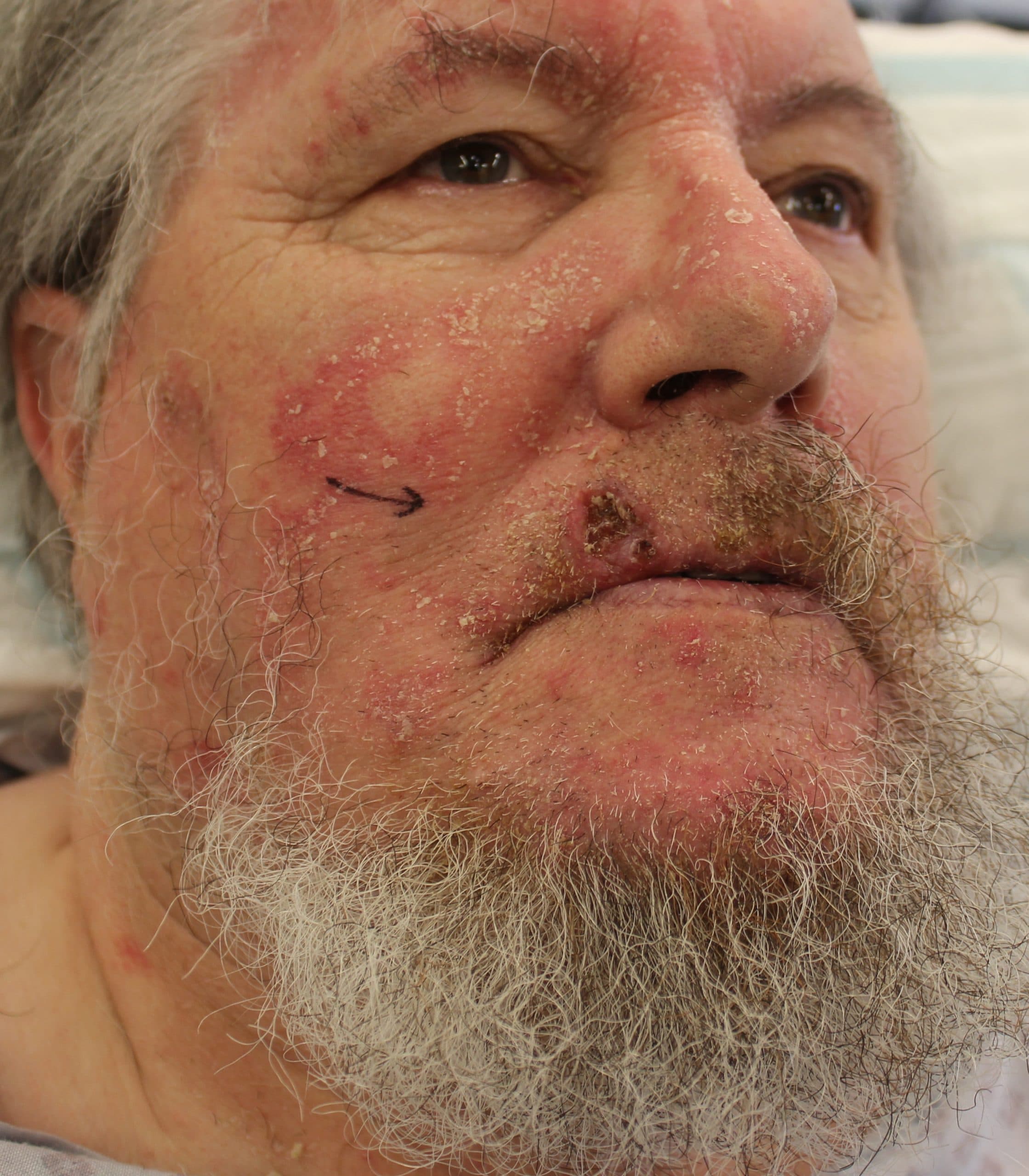 Skin Cancer Surgery