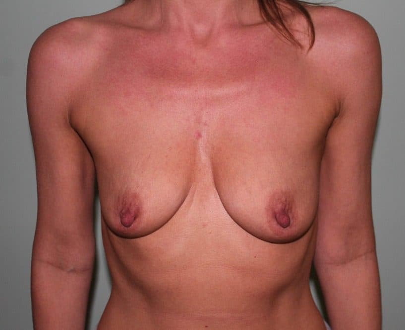 Breast Enlargement