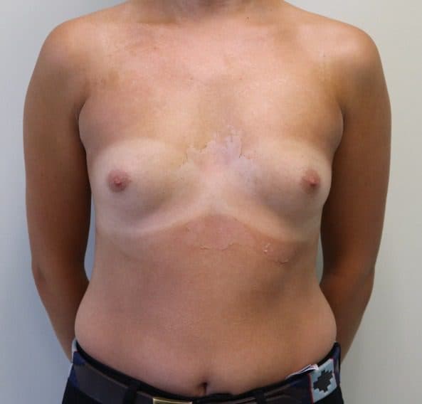 Breast Enlargement