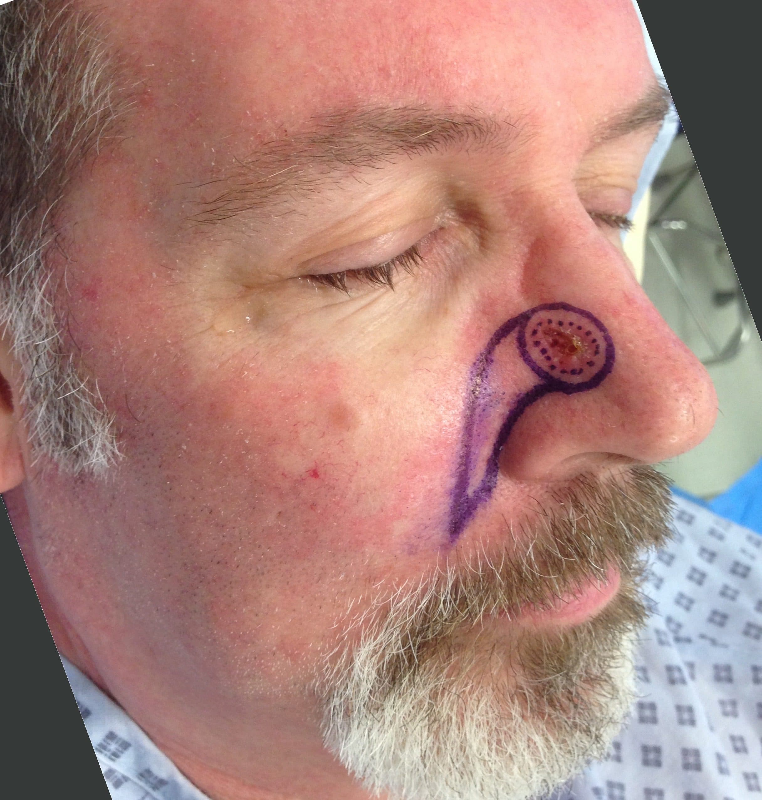Skin Cancer Surgery