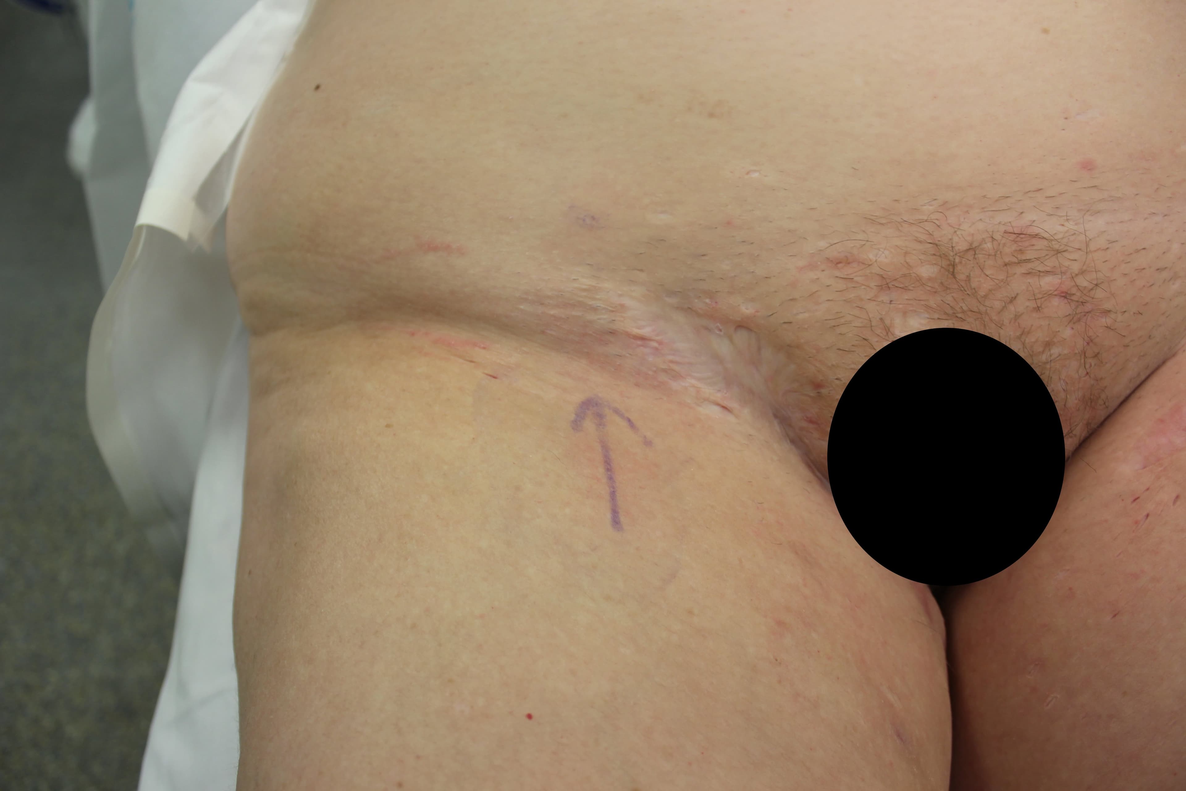 Groin Hidradenitis Supprativa Surgery