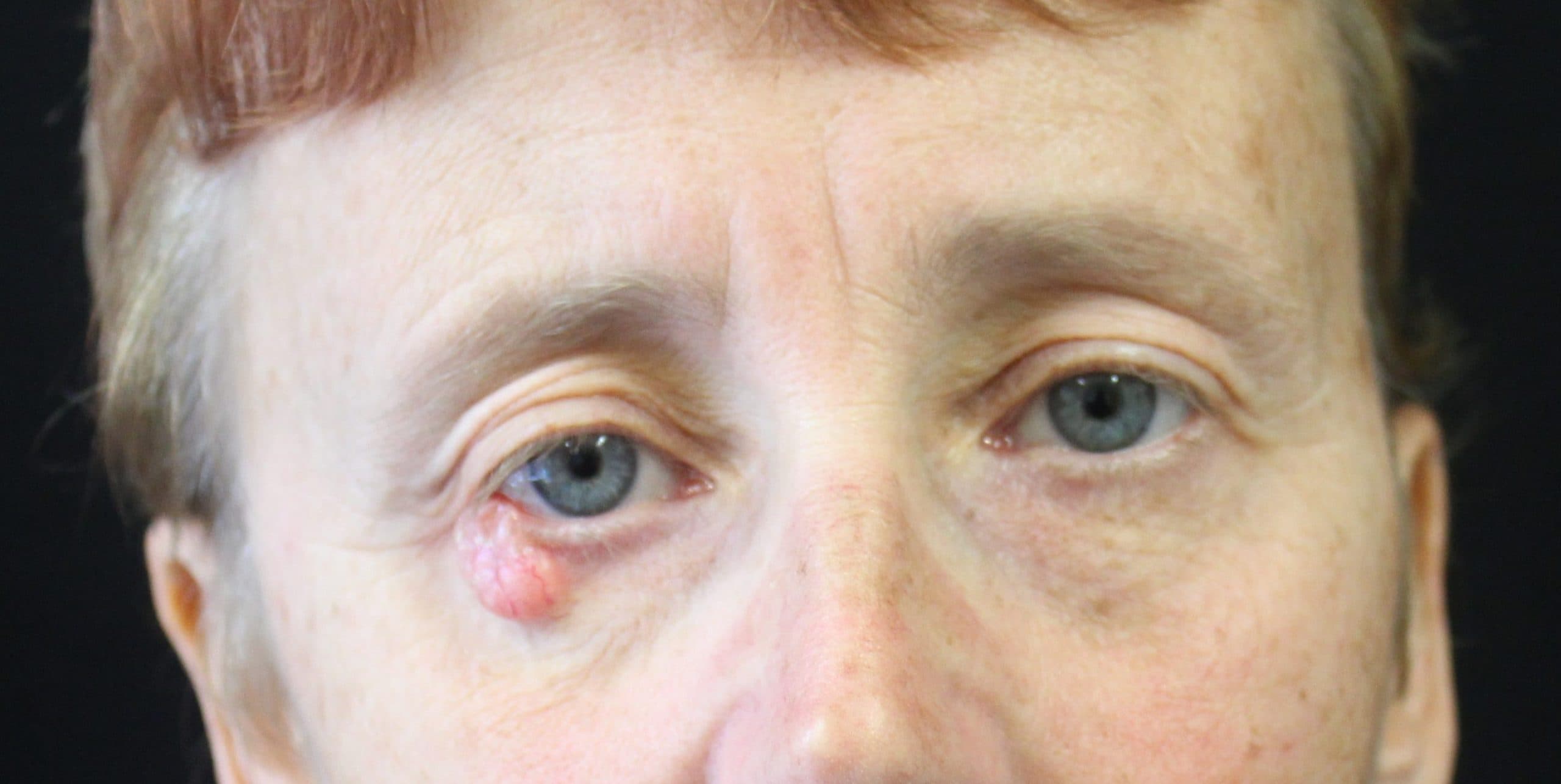 Skin Cancer Surgery