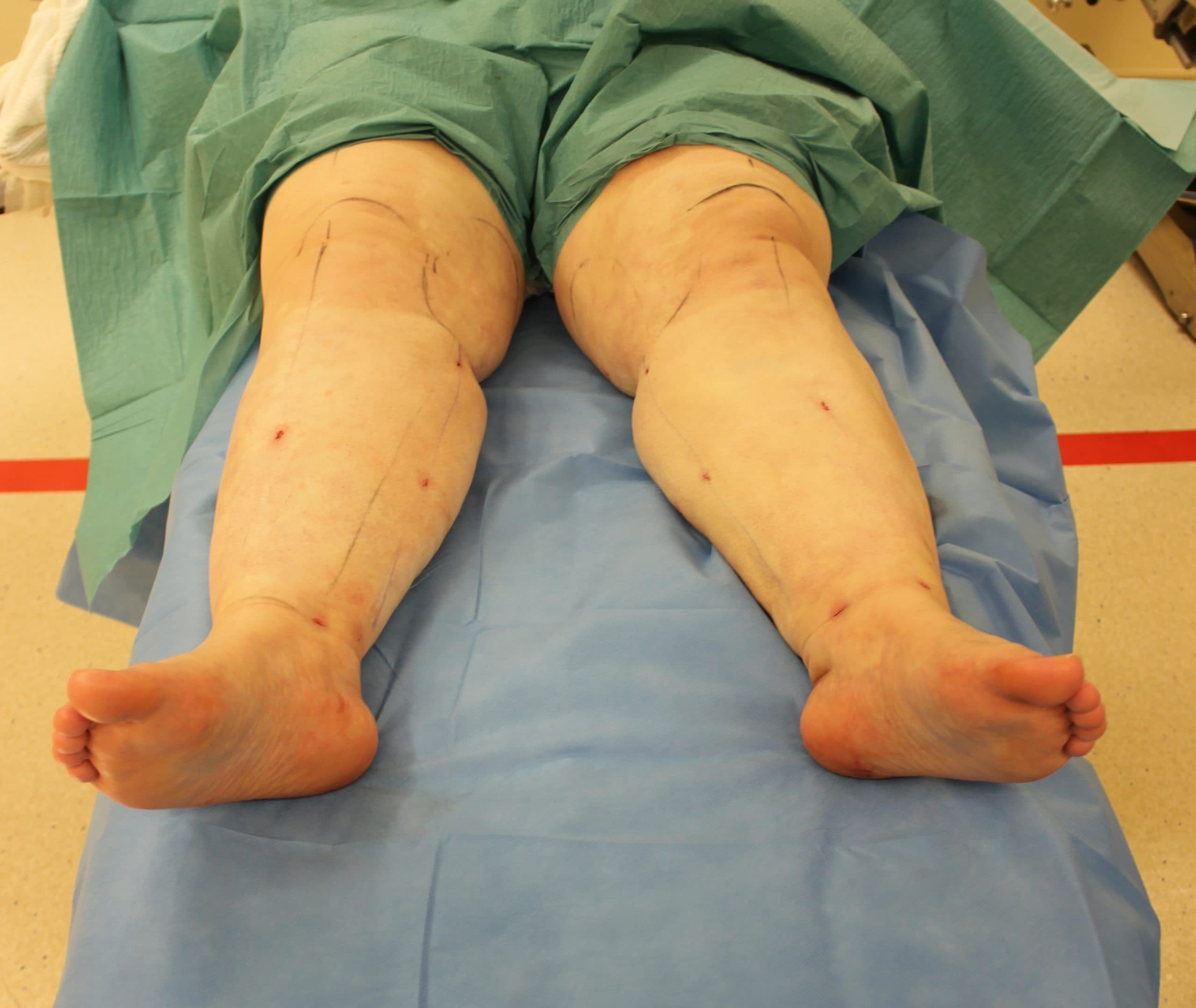 Lower Limb Lipoedema Liposuction Post-op Progress