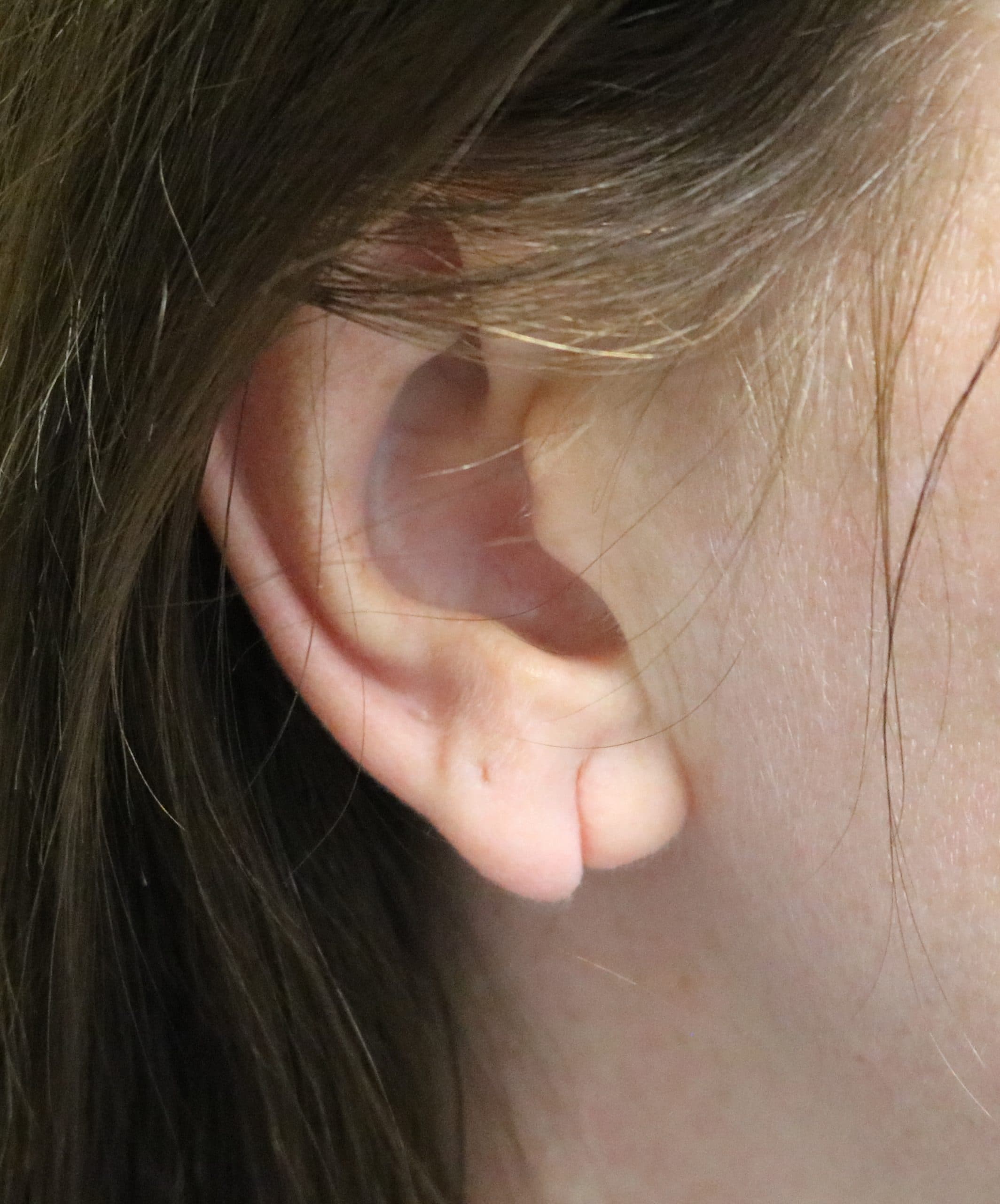 Earlobe Repair