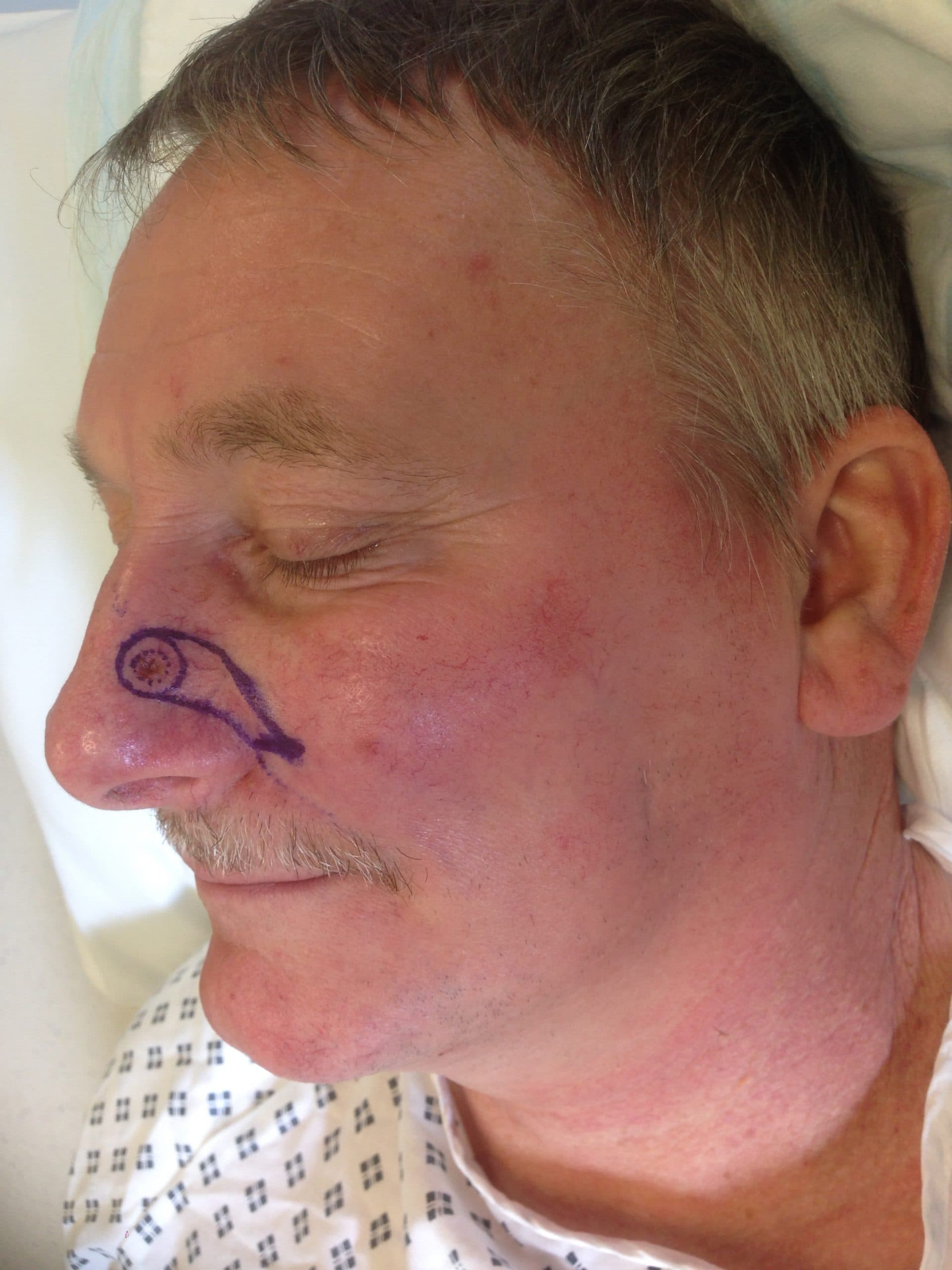 Skin Cancer Surgery