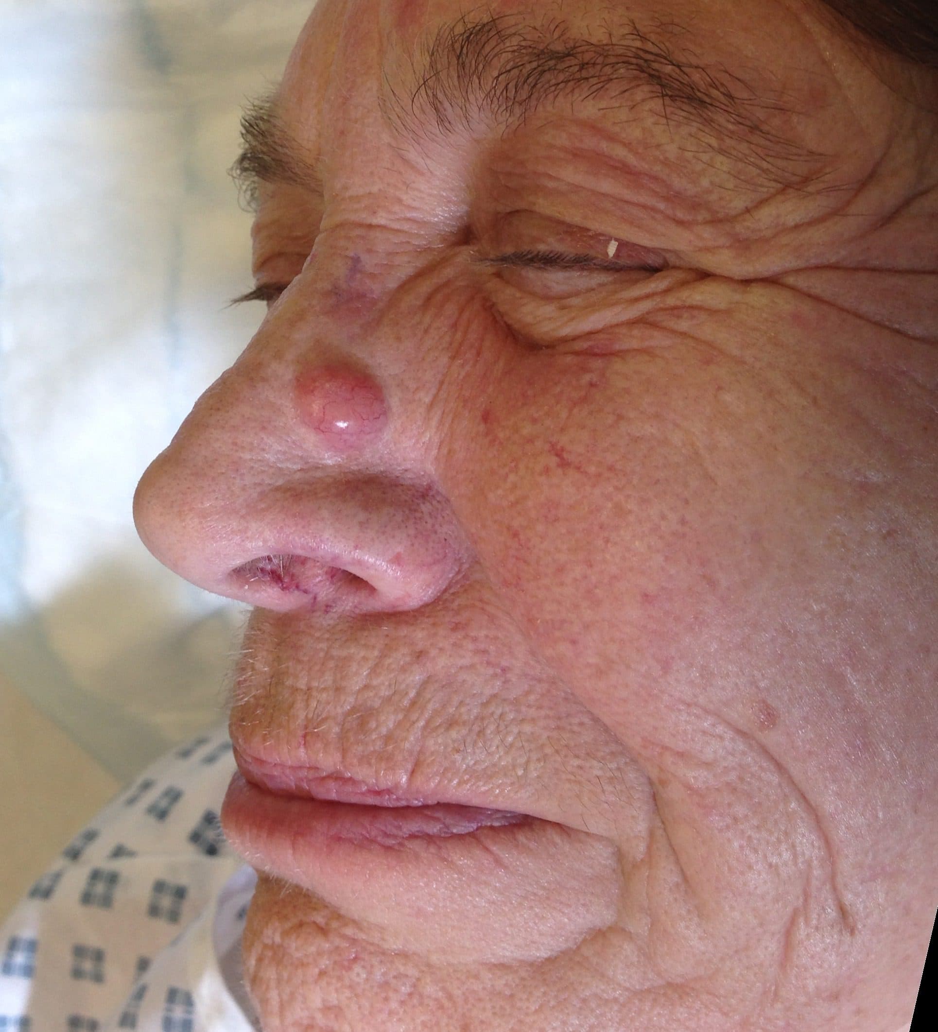 Skin Cancer Surgery