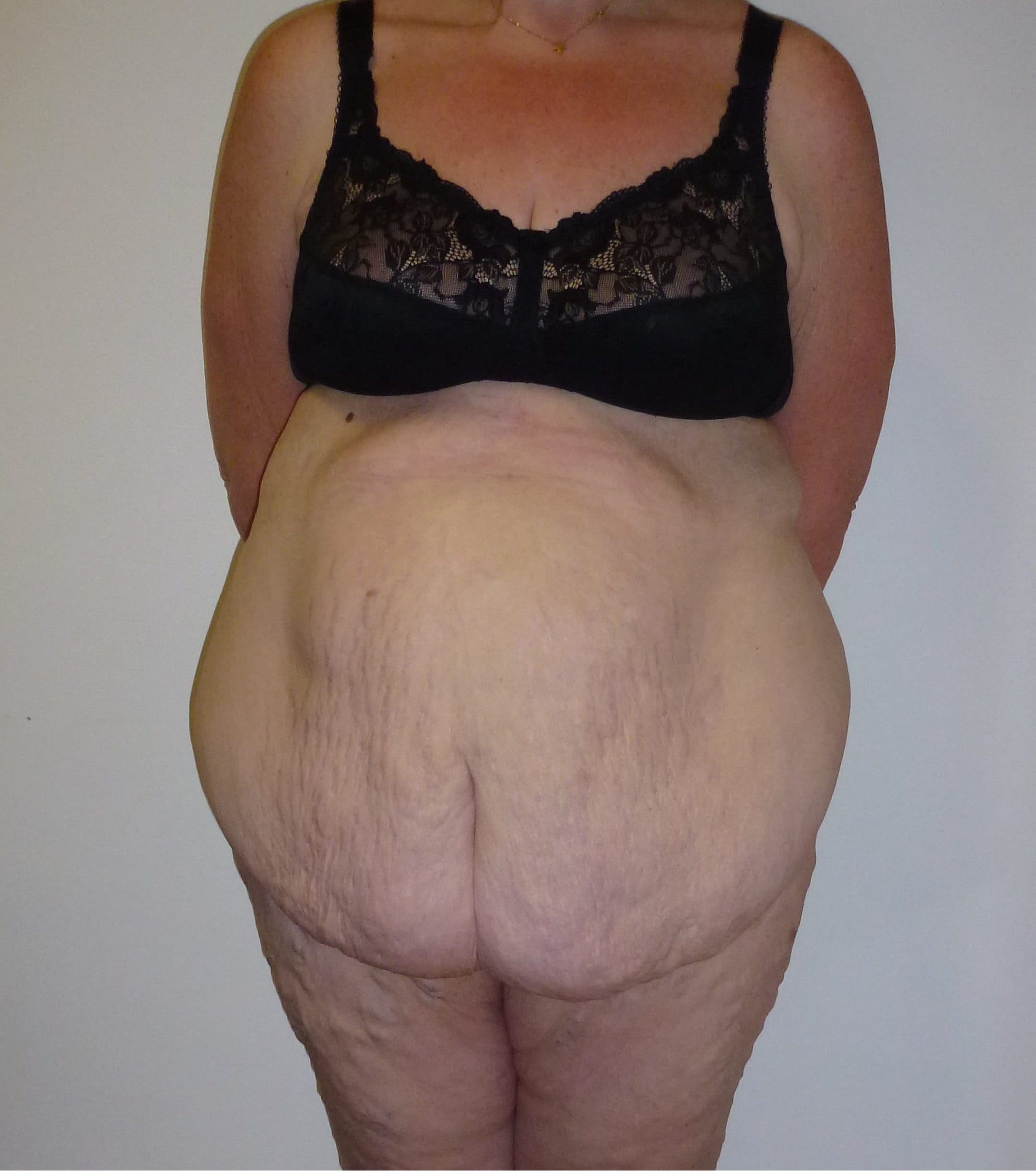 Tummy Tuck (Abdominoplasty)