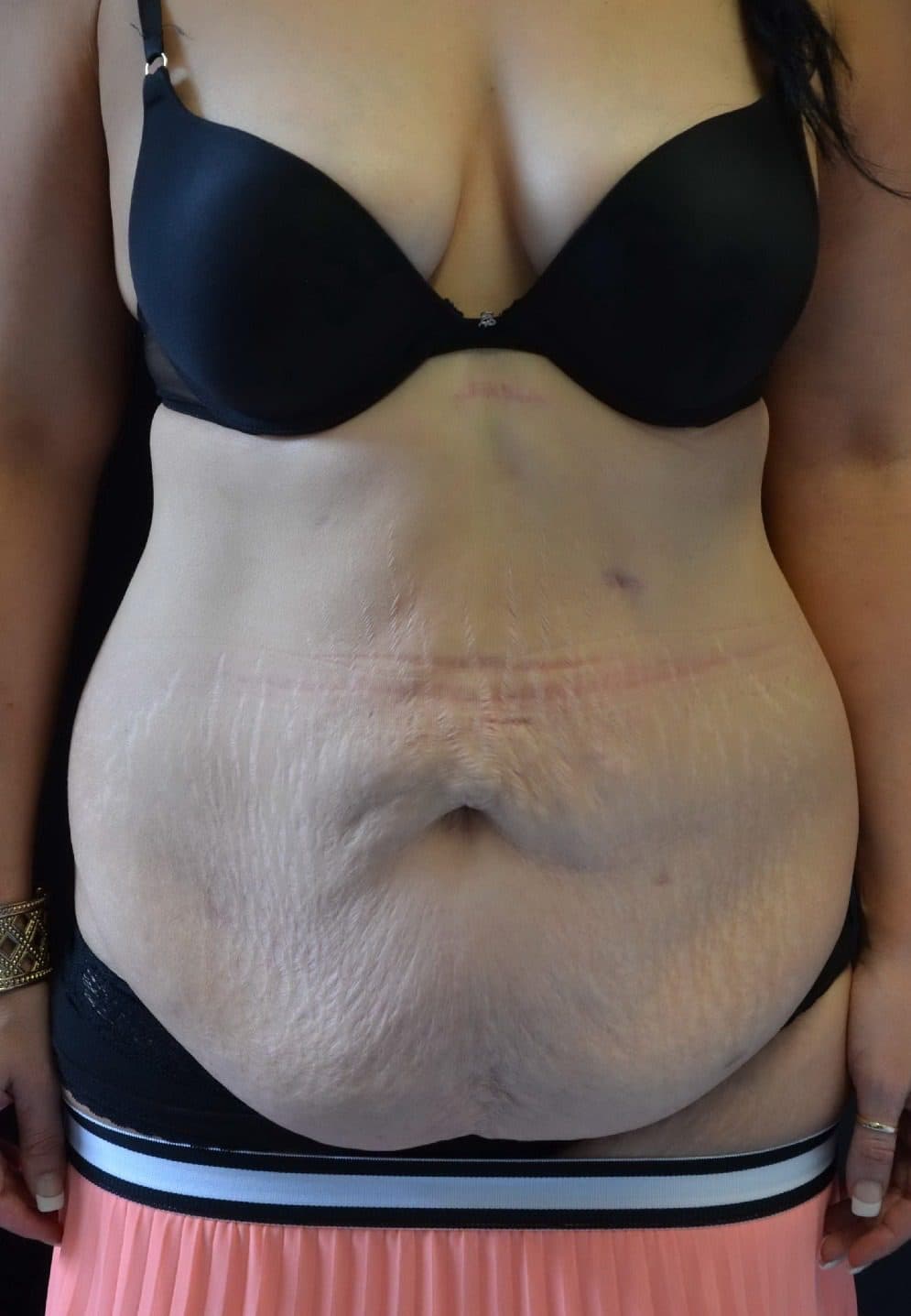 Fleur-de-lis Tummy Tuck (Abdominoplasty)
