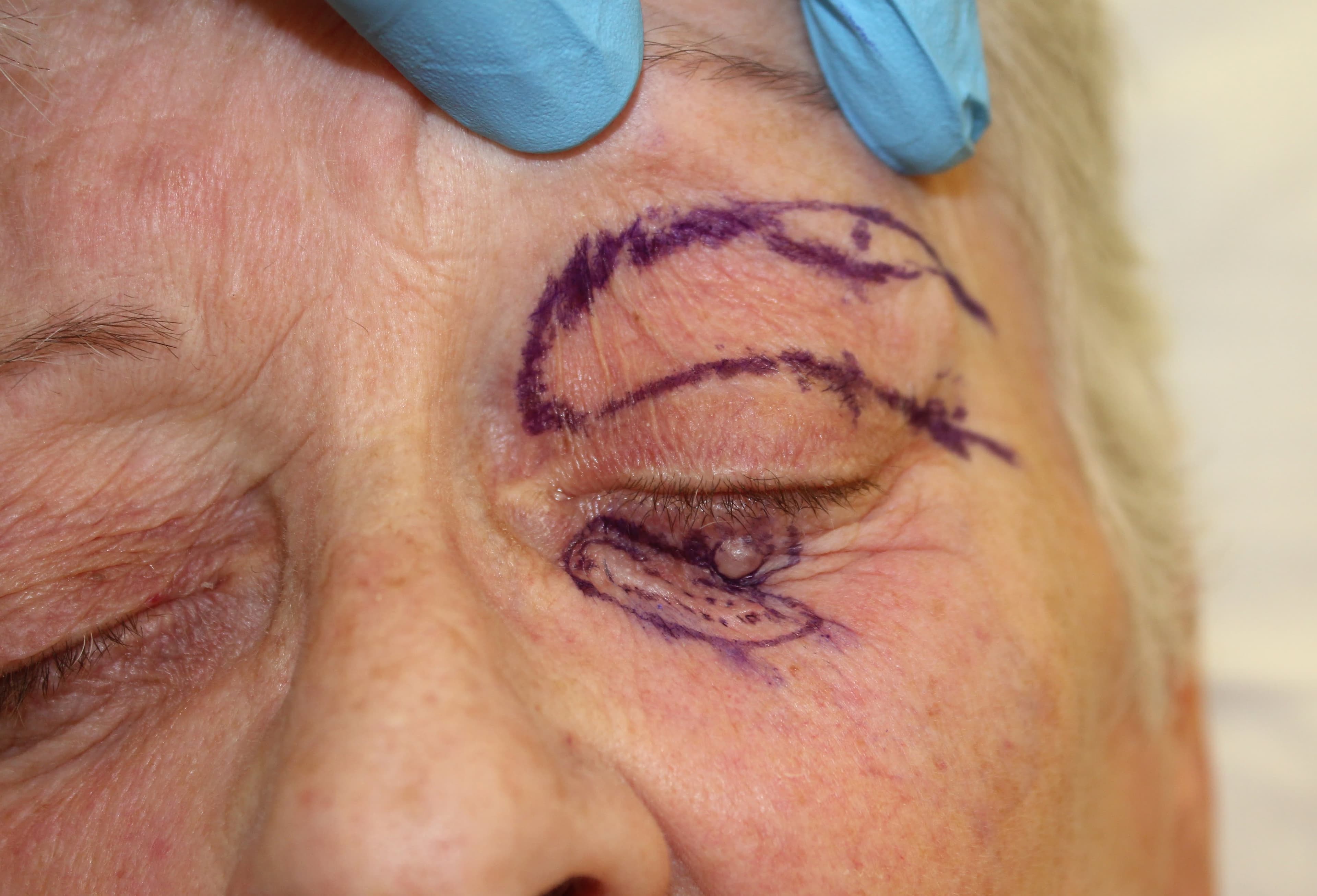 Skin Cancer Surgery