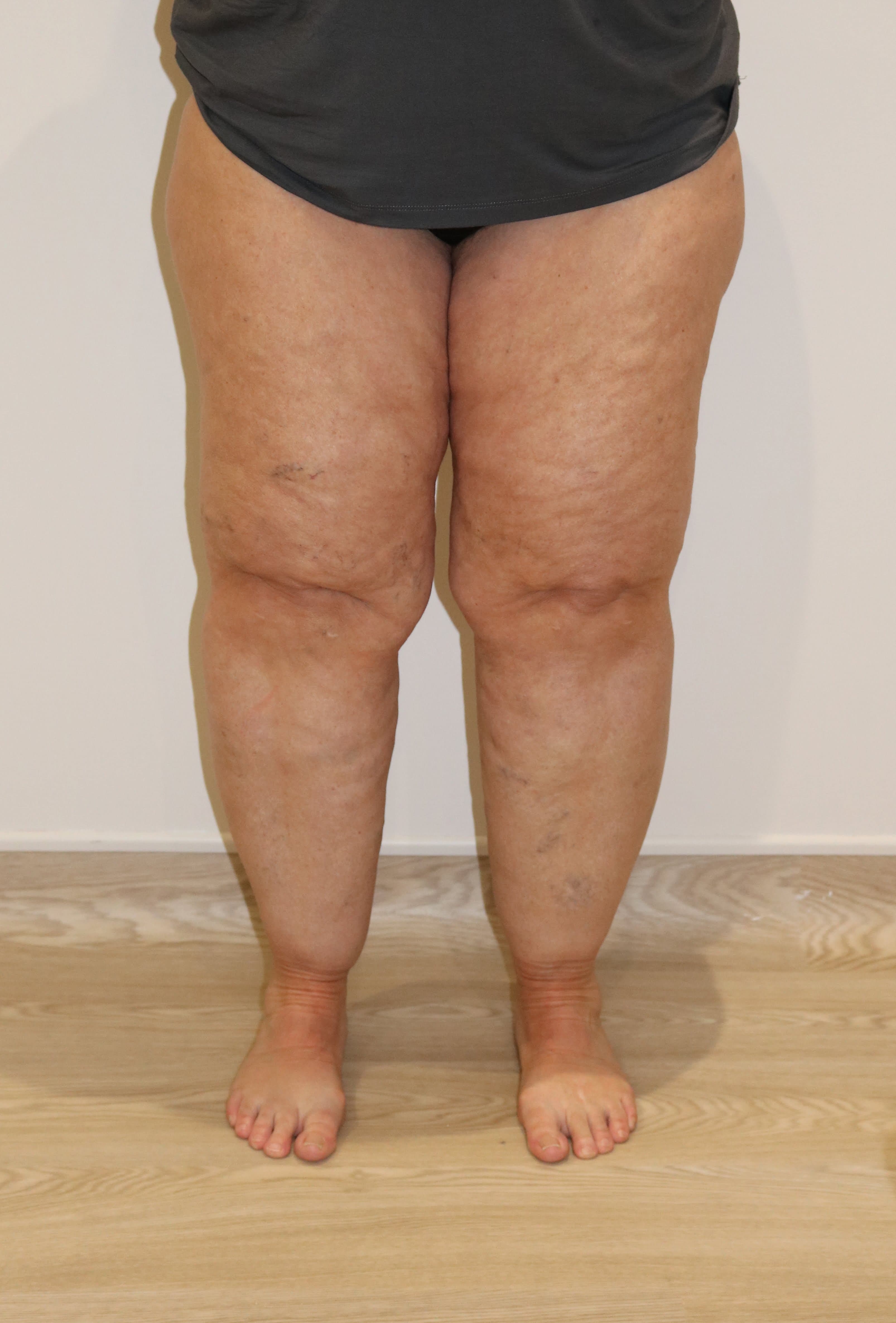 Lower Limb Lipoedema Liposuction