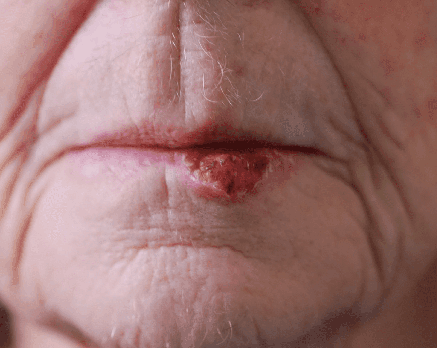 Skin Cancer Surgery
