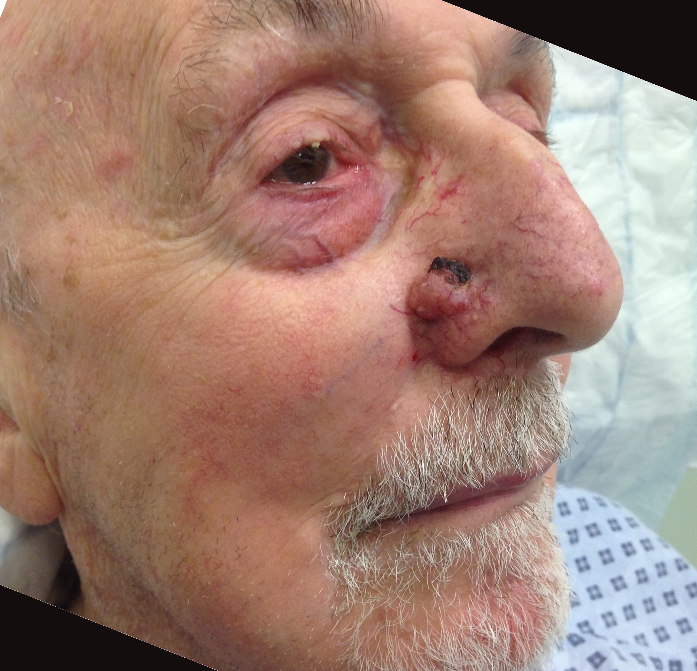 Skin Cancer Surgery
