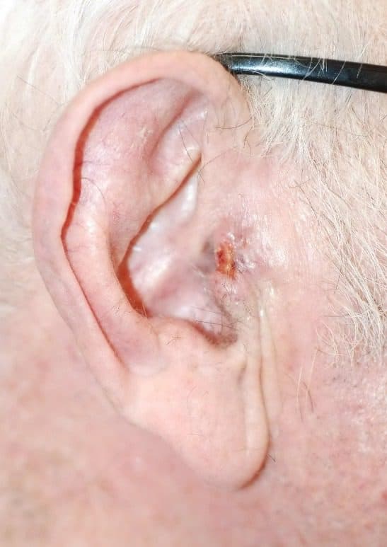 Skin Cancer Surgery