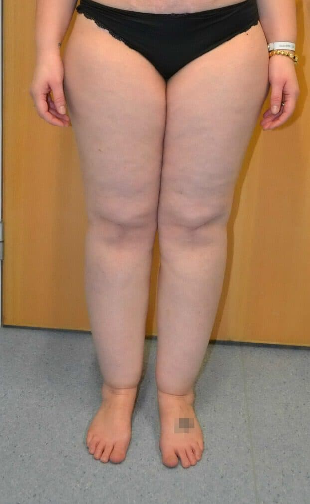 Lower Limb Lipoedema Liposuction