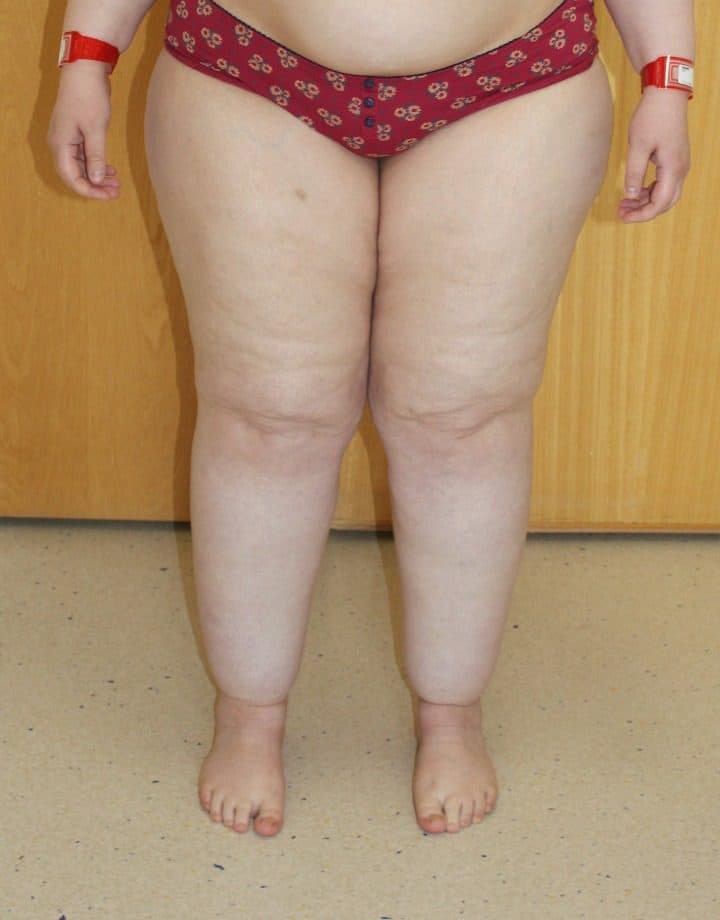 Lower Limb Lipoedema Liposuction