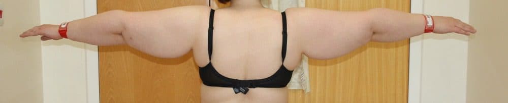 Arm Lipoedema Liposuction