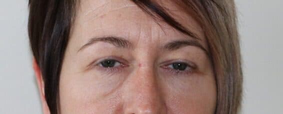 Lower Blepharoplasty