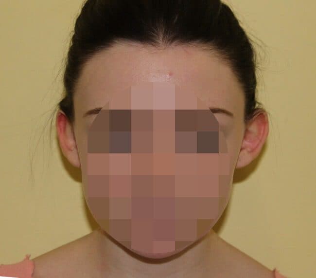 Prominent Ear Correction (Otoplasty / Pinnaplasty)