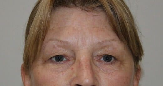 Upper Blepharoplasty