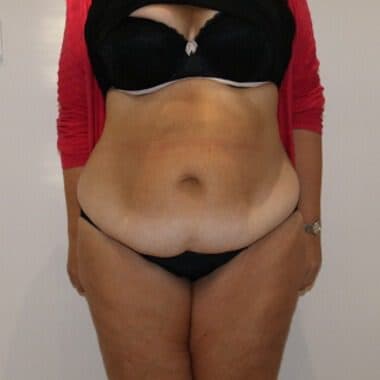 Brazilian Tummy Tuck