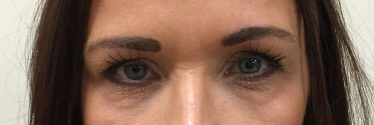 Lower Blepharoplasty