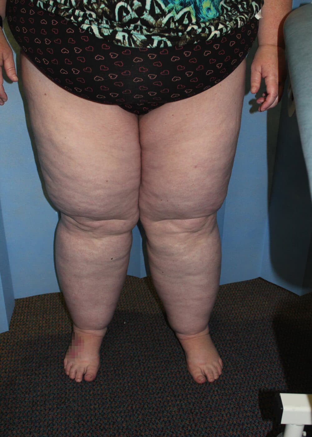 Lower Limb Lipoedema Liposuction