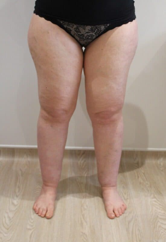 Lower Limb Lipoedema Liposuction