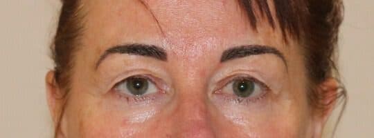 Upper Blepharoplasty
