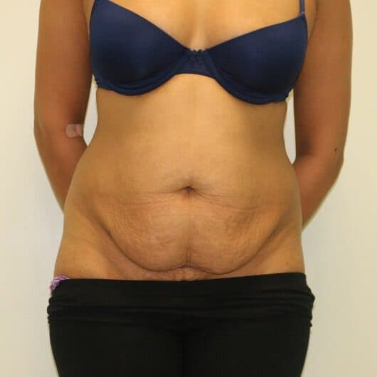 Brazilian Tummy Tuck