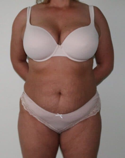 Brazilian Tummy Tuck