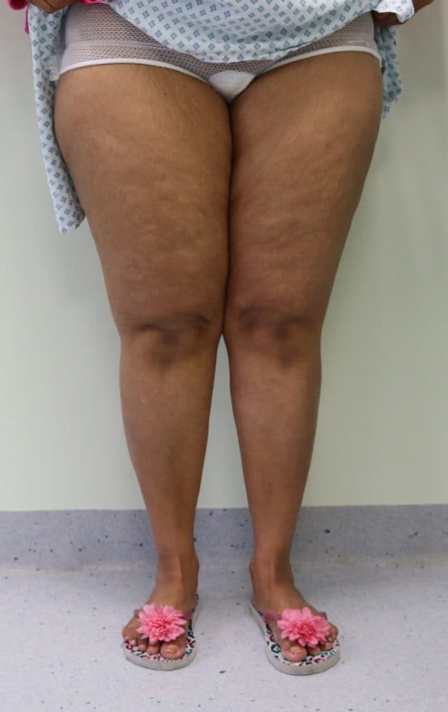 Lower Limb Lipoedema Liposuction