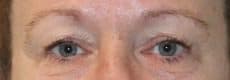 Upper Blepharoplasty