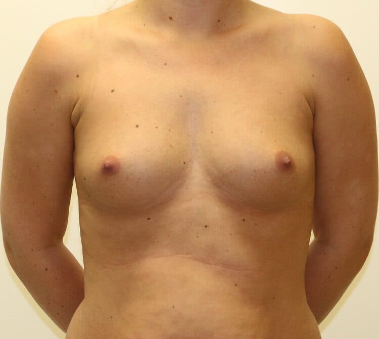 Breast Enlargement