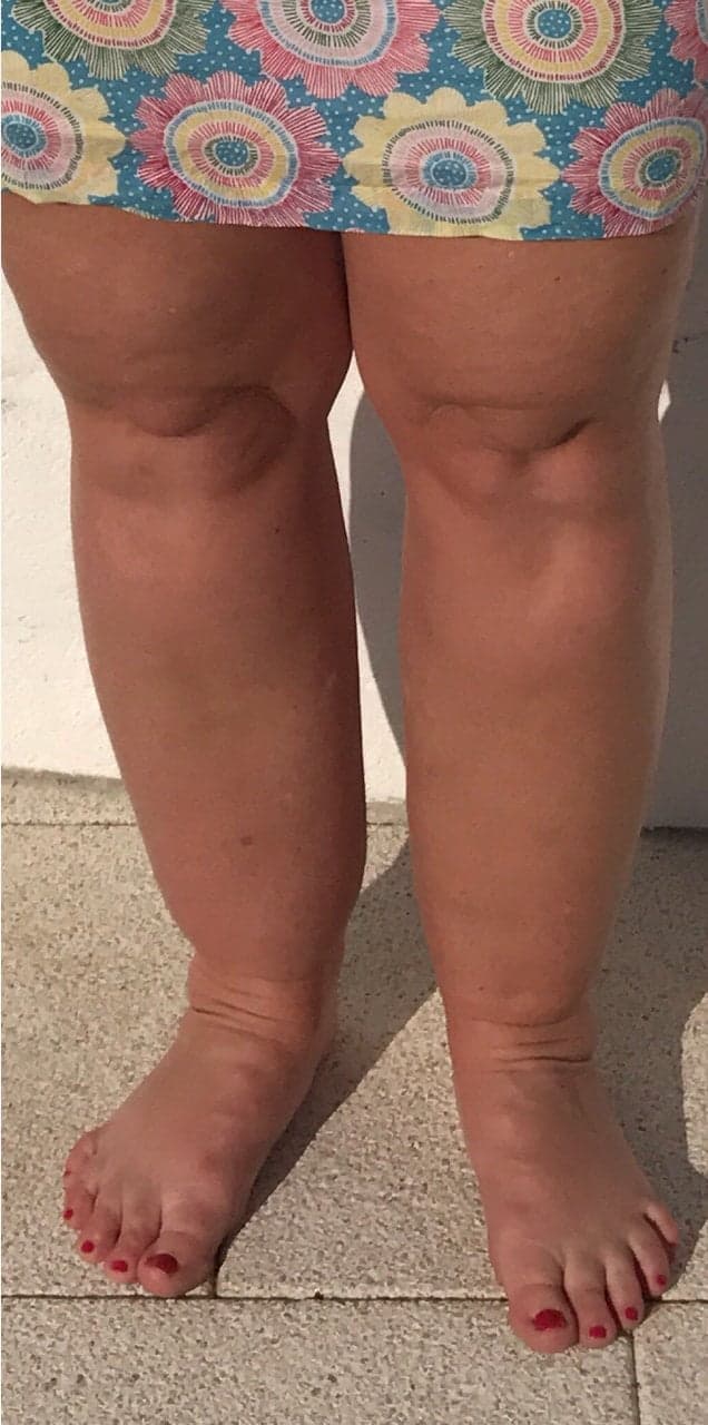 Lower Limb Lipoedema Liposuction