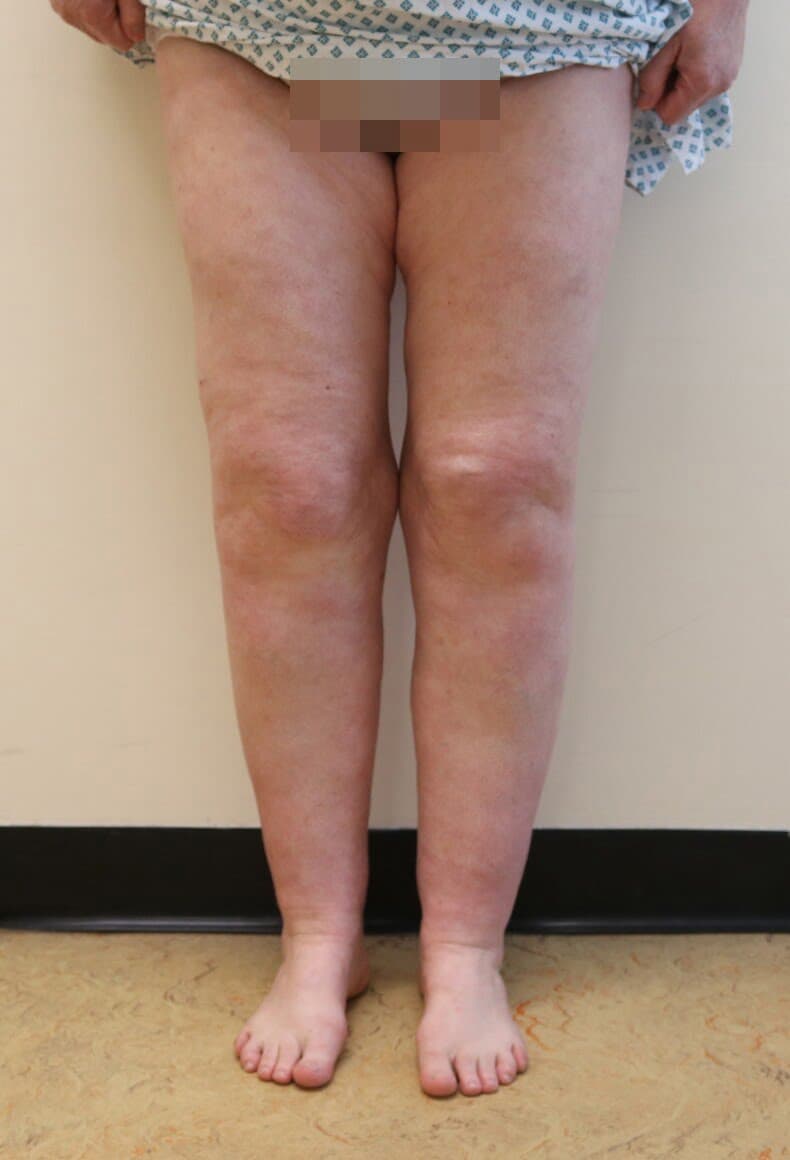 Lower Limb Lipoedema Liposuction