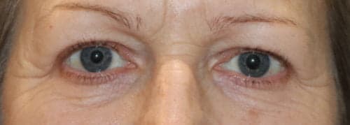 Upper Blepharoplasty