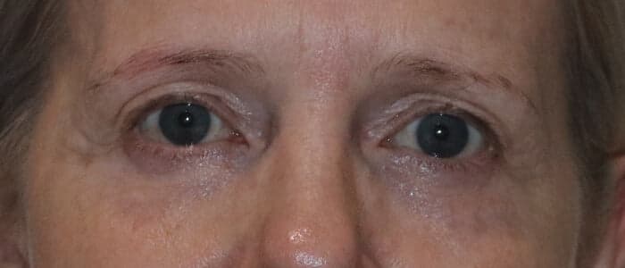 Direct Brow Lift & Upper Blepharoplasty
