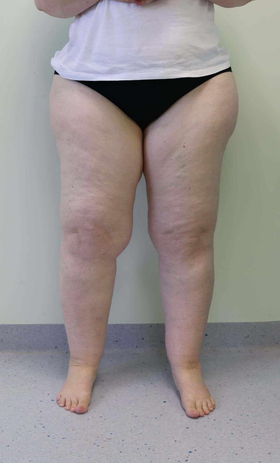 Lower Limb Lipoedema Liposuction