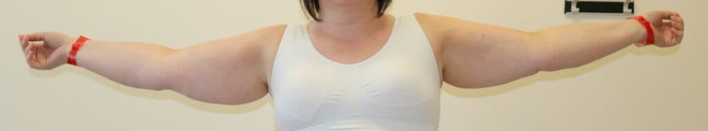 Arm Lipoedema Liposuction